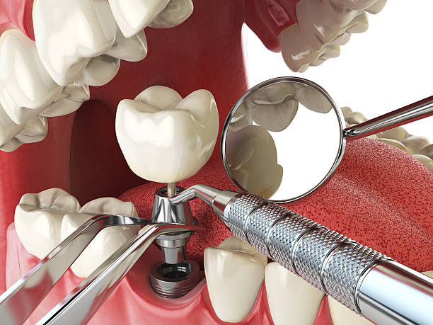 Best Emergency Tooth Extraction in Emeryville, CA